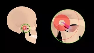 Ear Pain Due to TMJ (Jaw Joint) Disorders