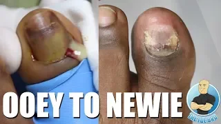 GOOEY FUNGAL TOENAIL REMOVAL TREATMENT CHECK UP