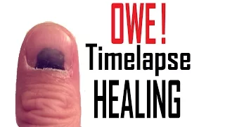 Smashed Thumb Nail Healing Timelapse