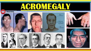 ACROMEGALY | GROWTH HORMONE EXCESSIVENESS | GROWTH HORMONE INCRESING PROBLEM | NURSING | GNM | MBBS