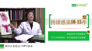 人乳頭瘤病毒（HPV）感染後多長時間才可能引起宮頸癌？How long does it take for human papillomavirus (HPV) to ca..