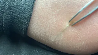 Satisfying Splinter removal