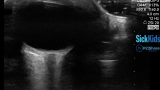 Diagnosing An Orbital Abscess Using Ocular POCUS