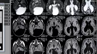 Film reading of brain imaging Dr Hassan El kiki Part 1