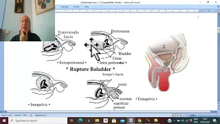 Trauma in Arabic 35 ( Intra-peritoneal Injury of Urinary Bladder ) , by Dr. Wahdan .