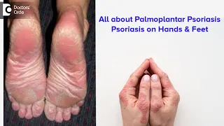 All about Palmoplantar Psoriasis | Psoriasis on hands & feet - Dr. Rajdeep Mysore | Doctors' Circle