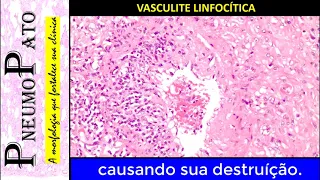 Minuto PneumoPato - Vasculite Linfocítica