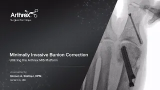 Minimally Invasive Bunion Correction Utilizing the Arthrex MIS Platform