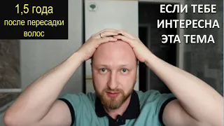 ПОЛТОРА ГОДА после пересадки волос (FUE, 4500 графтов, Стамбул).