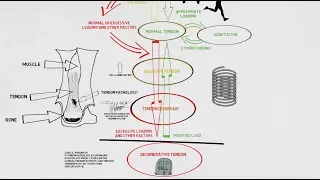 Tendinopathy Continuum and Update!