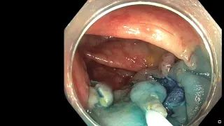 Endoscopic Removal of Massive Serrated Polyp: How to Guide for Patients