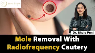 Mole Removal With Radiofrequency Cautery