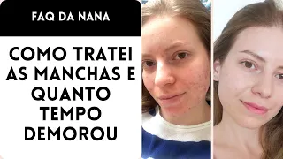 Opções de Tratamento para MANCHAS DE ACNE | Quanto tempo demora, produtos e procedimentos