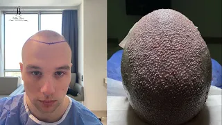 Hair transplant - 5000 grafts transplanted per one session