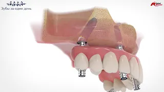 Технология All On 4 | Как происходит установка протеза | Сеть клиник "Зубы за один день"