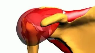 Rotator cuff tear and Deltoid muscle