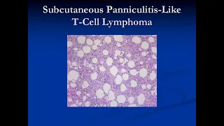 7 5 Subcutaneous panniculitis-like T-cell lymphoma PTCL