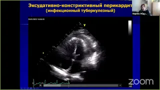 Особенности эхокардиографической диагностики перикардитов