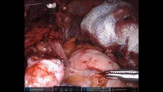 Robotic Gastric Pouch revision and Candy Cane Resection for weight regain after LRYGB
