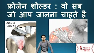 फ्रोजेन शोल्डर : वो सब जो आप जानना चाहते है  Frozen shoulder :Don't get Frustated( Hindi)