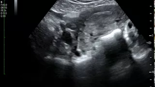 Ectopic Pregnancy, Ultrasound.  JETem 2017