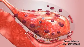 Retention of Placenta 3D Animation in Hindi made by Bluechisel