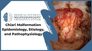 Chiari Malformation Epidemiology, Etiology, and Pathophysiology