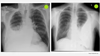 New insights into Pleural Infection