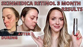 SKINMEDICA RETINOL HONEST REVIEW & 3 MONTH RESULTS| Is Medical Grade Skincare Worth It?