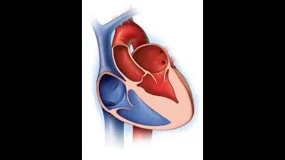 Sakamoto (Yamaguchi syndrome), or apical hypertrophic cardiomyopathy (ApHCM)