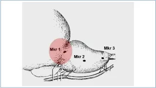 Fiducial Marker Implantation