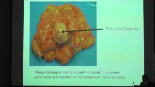 Доклад хирурга Национального института рака Олега Сидорчука