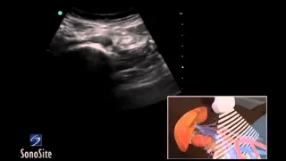How To: Abdominal Aorta Ultrasound 3D Video
