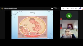 Multiple Pregnancy and Anemia in Pregnancy - PRIME Obstetric and Gynaecology by Prof Hamizah