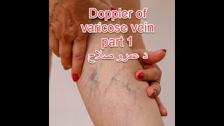 Doppler of varicose veins part1 د عمرو صلاح