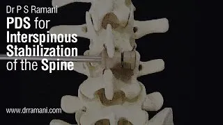 07 Interspinous Stabilization of the Spine