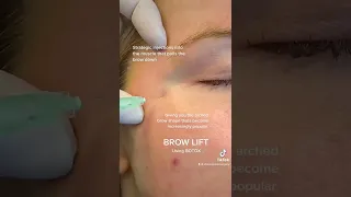 How to Safely & Effectively Use Botox for Brow Lift