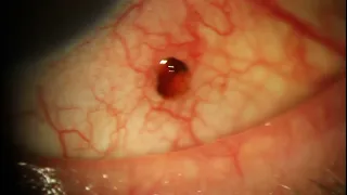 Mystery Foreign Body Removed from Eye Conjunctiva