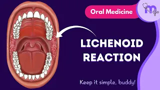 Lichenoid Reaction - Etiology , Diagnosis , Classification | Oral Medicine | Animated Explanation