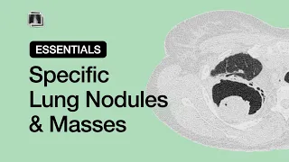 Specific Lung Nodules & Masses | Chest Radiology Essentials