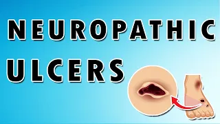Neuropathic Ulcer on Foot - Treatment, Symptoms, and Pain [Dermatology Course 44/60]
