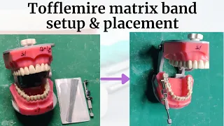 Tofflemire Retainer Parts, Matrix Band  (setup and placement) | Universal Matrix | Matricing |