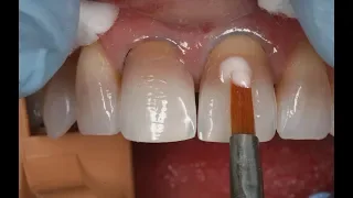 Masking the dark tooth with direct resin | Dental Online Training