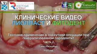 Клиническое видео Лиопласт и Фитодент № 3 Часть 2