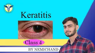 Keratitis