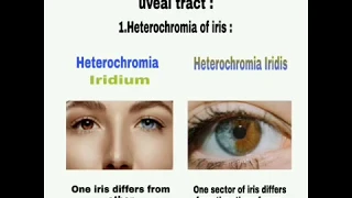 Congenital anomalies of uveal tract || Easier way || with diagrams