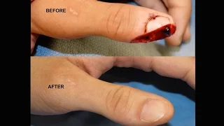 Amazing Thumb Tip Regeneration! IV3000 Wound Dressing for Thumb / Finger Trauma