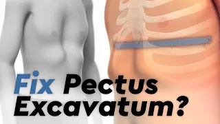 Pectus Excavatum and the Nuss Procedure
