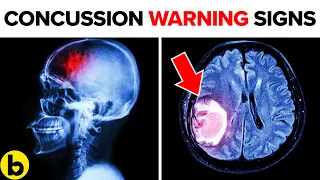 8 Warning Signs That You Have A Concussion