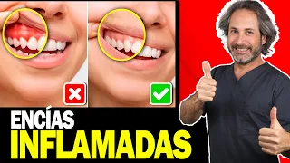 😨 Que hacer si tengo ENCIAS INFLAMADAS Y SANGRANTES - Causas y Tratamientos (Que SI FUNCIONAN ✅)